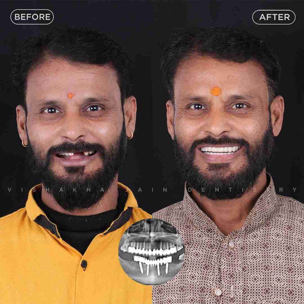 best-dental-implants-indore