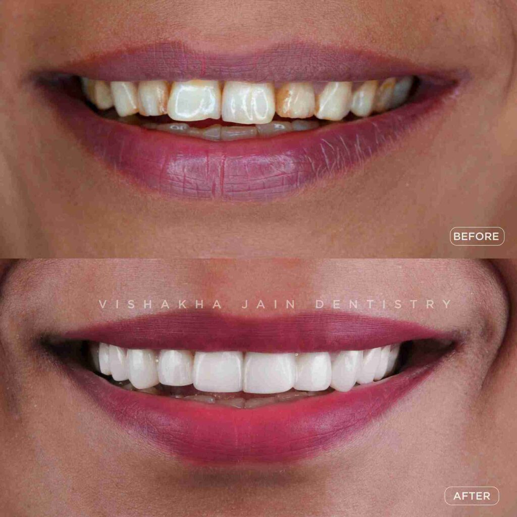 best-dental-venners-indore