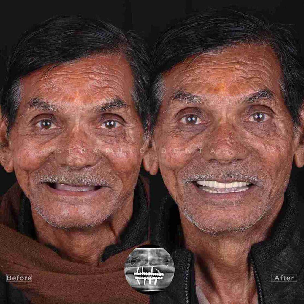 dental-implants-indore