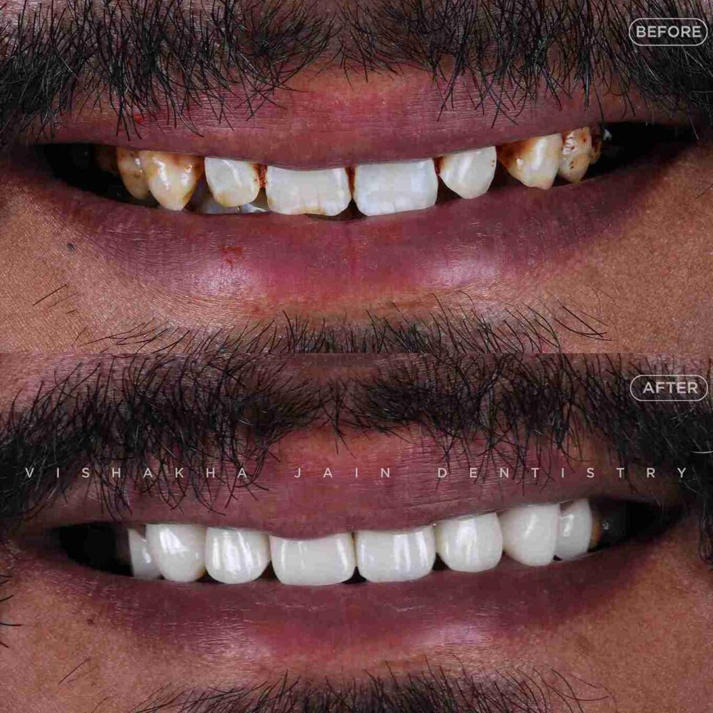 teeth-whitening-in-indore